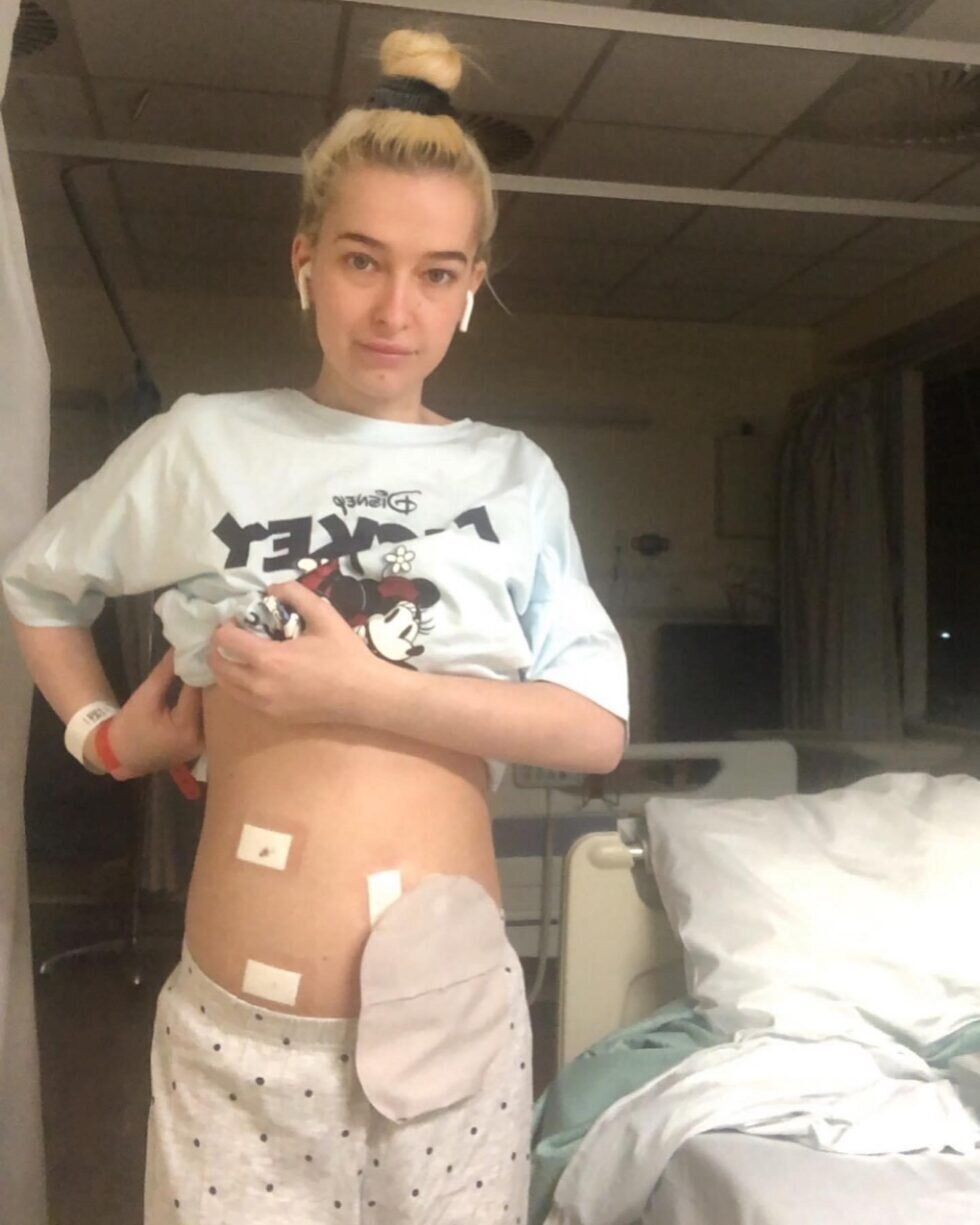 sepsis story with a stoma