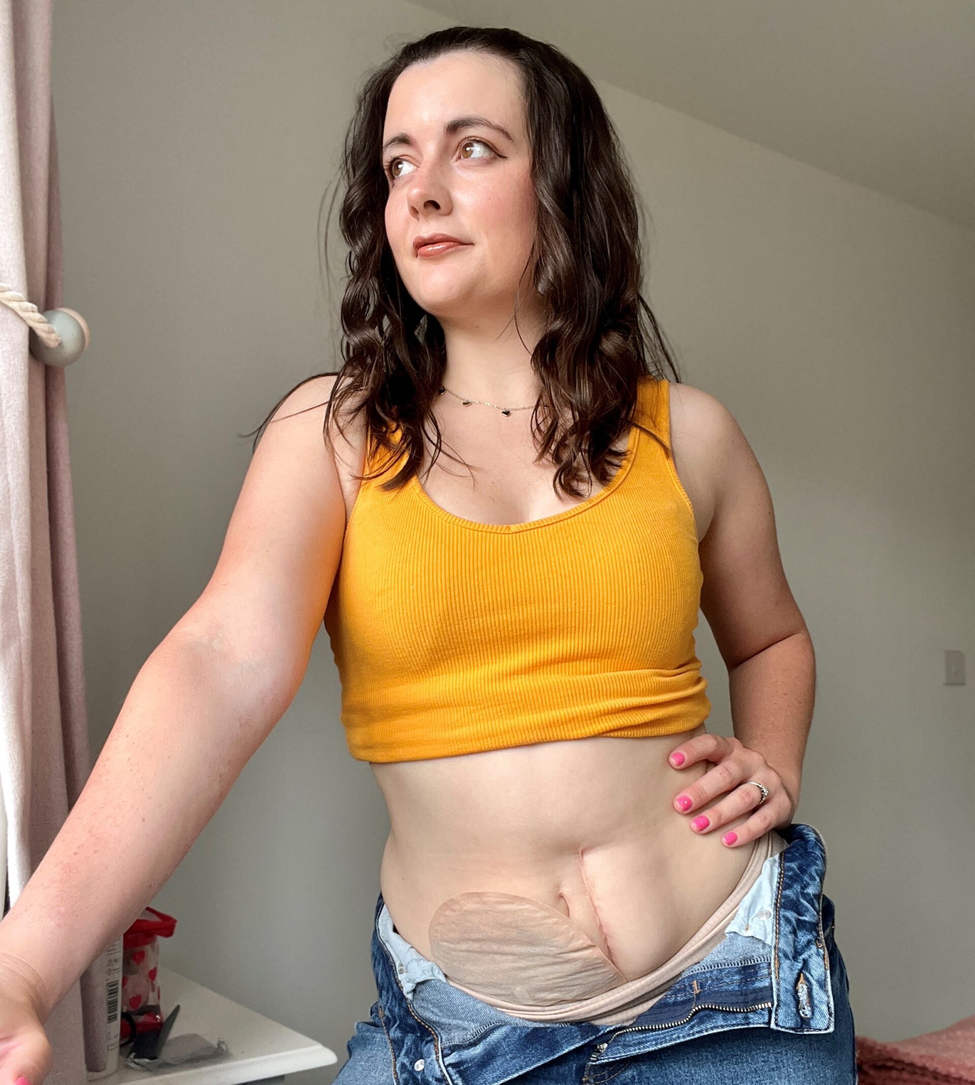 Amy, in a yellow top and jeans strikes a pose for a photo, proudly displaying her stoma bag.